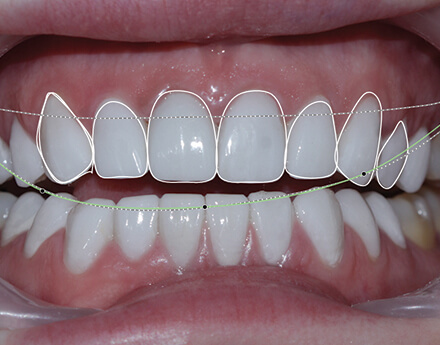 Smile Designing